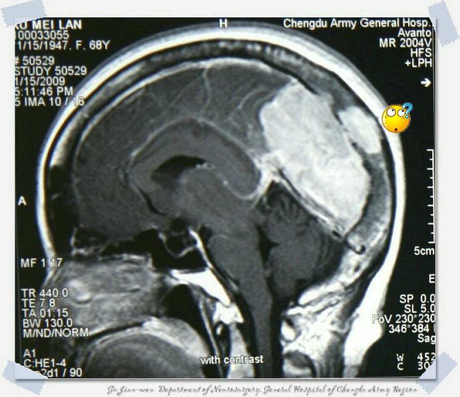 脑肿瘤是不是引发癫痫病的原因